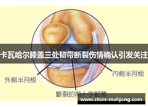 卡瓦哈尔膝盖三处韧带断裂伤情确认引发关注